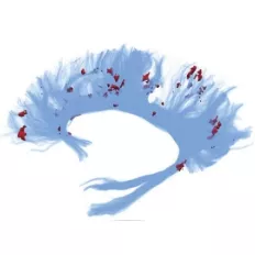 Imagerie du cerveau : fibres bleues avec taches rouges