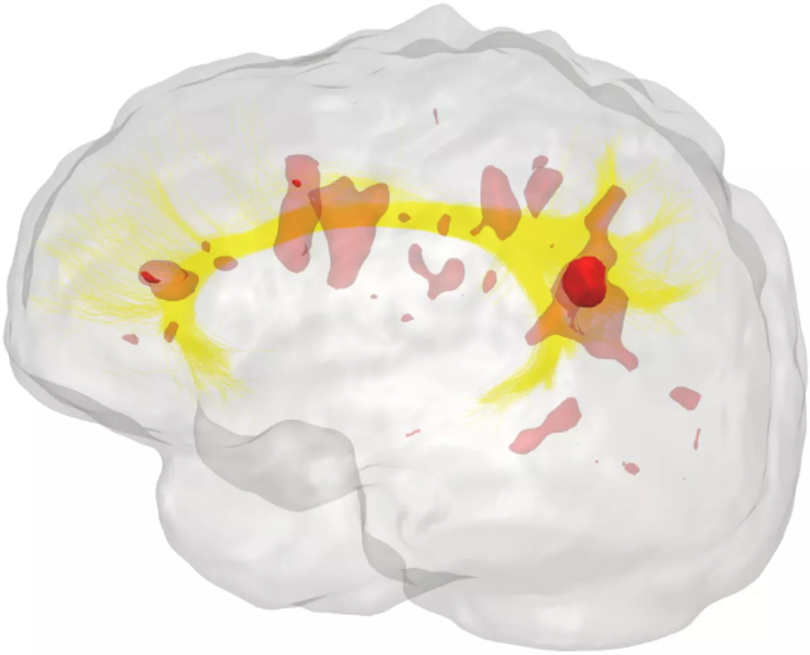 Imagerie du cerveau