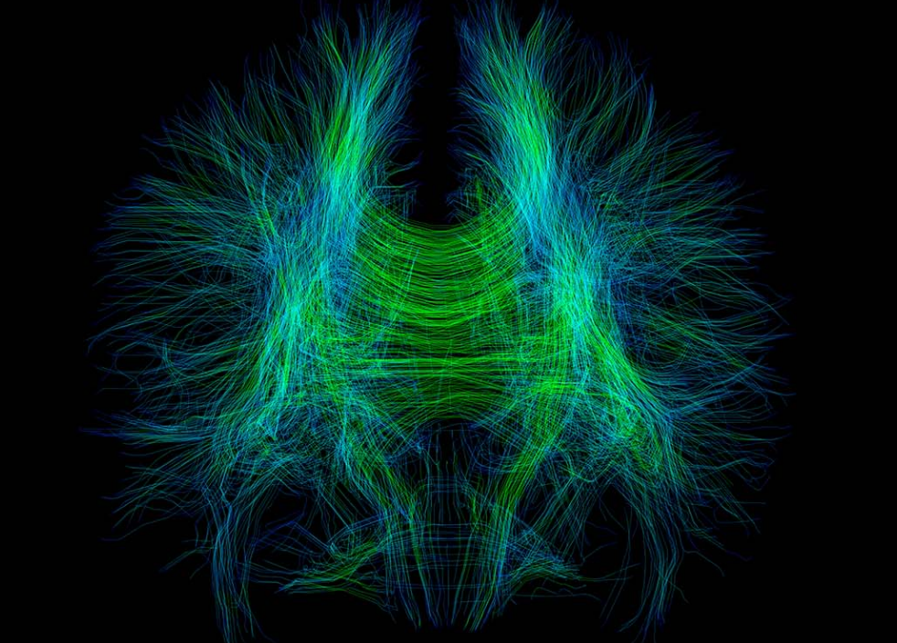 Diffusion Tensor Imaging