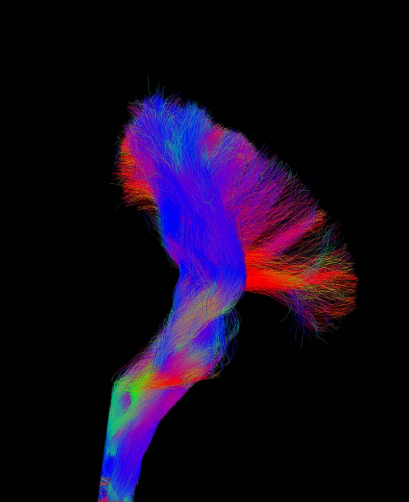 Diffusion Tensor Imaging