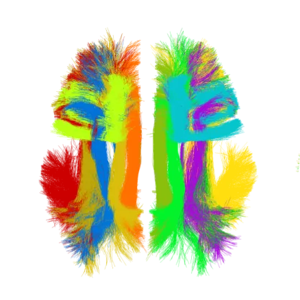 Brain scan : Blue, orange and green brain fibers