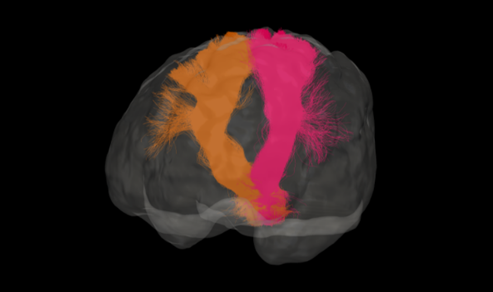 Brain scan: Orange and pink brain fibers